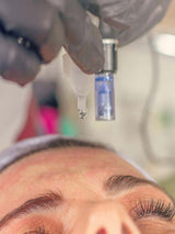 Mikroneedling Hyaluronsäure Behandlung